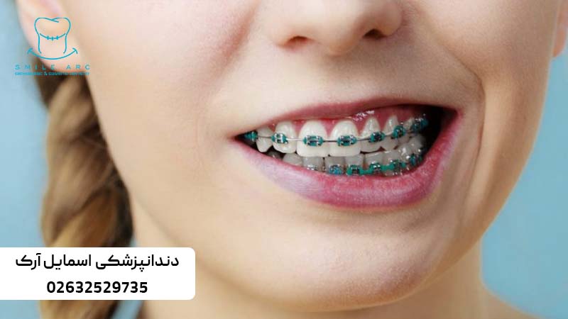 ارتودنسی دندان نیش نهفته