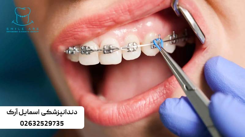 ارتودنسی دندان نیش نهفته