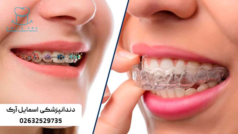 زمان استفاده از الاینر ارتودنسی