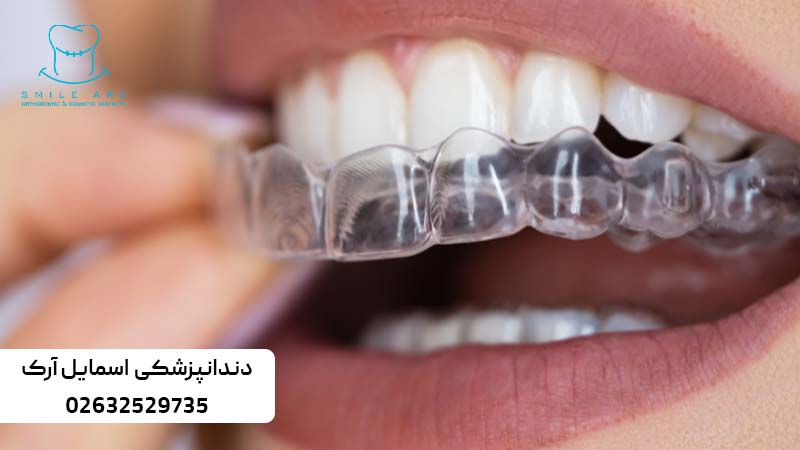 زمان استفاده از الاینر ارتودنسی