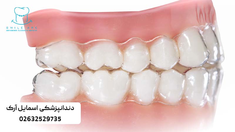 زمان استفاده از الاینر ارتودنسی
