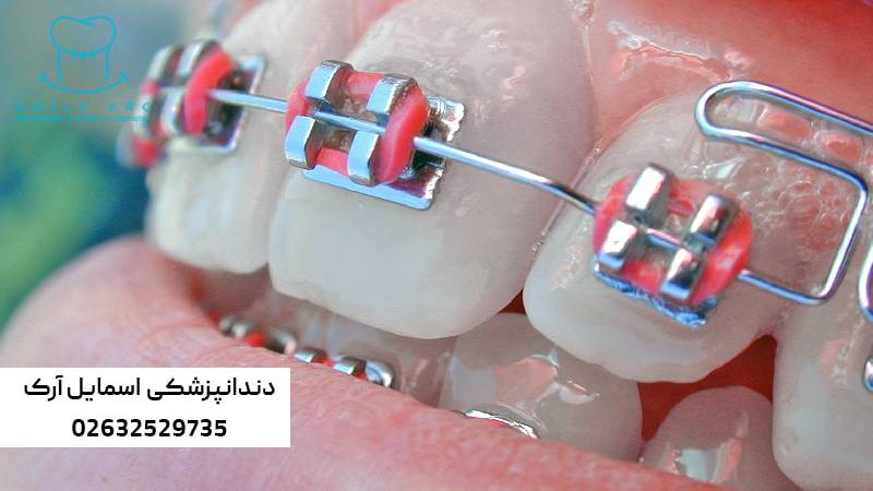 درد فک در ارتودنسی