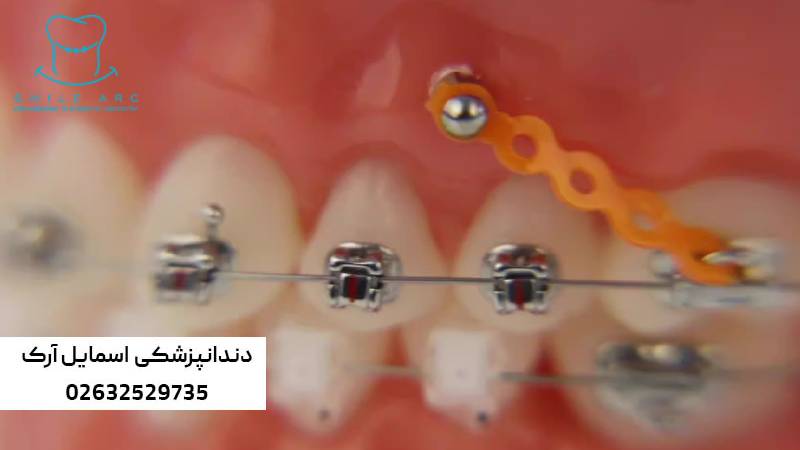 درد فک در ارتودنسی