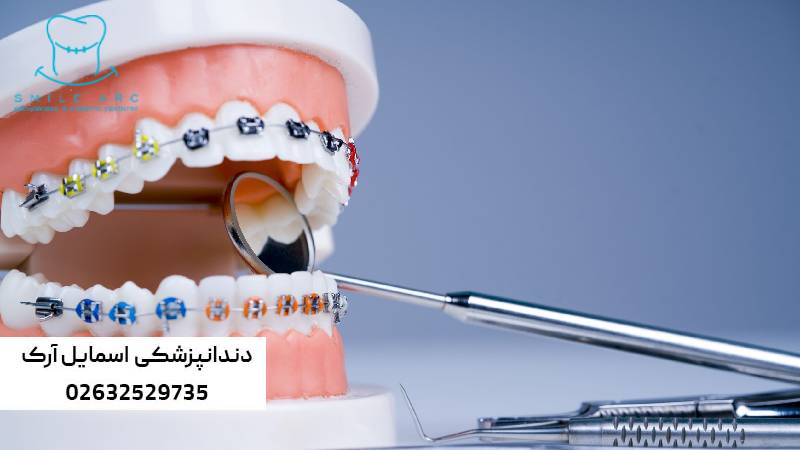 بهترین روش ارتودنسی