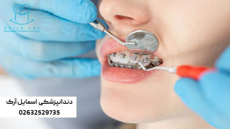 اصلاح بهم ریختگی دندان