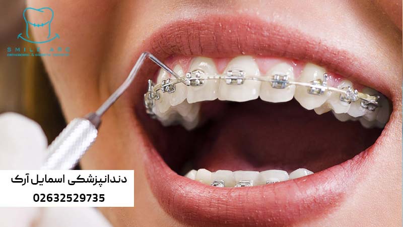 اصلاح بهم ریختگی دندان