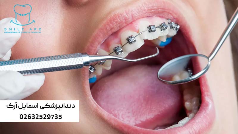 اصلاح بهم ریختگی دندان