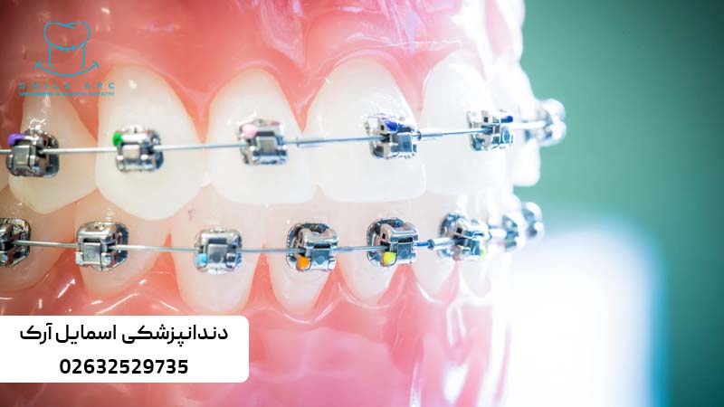 ارتودنسی کاموفلاژ