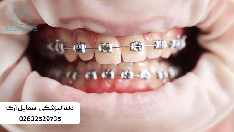 ارتودنسی کاموفلاژ