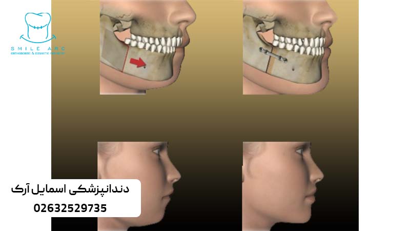 ارتودنسی کاموفلاژ