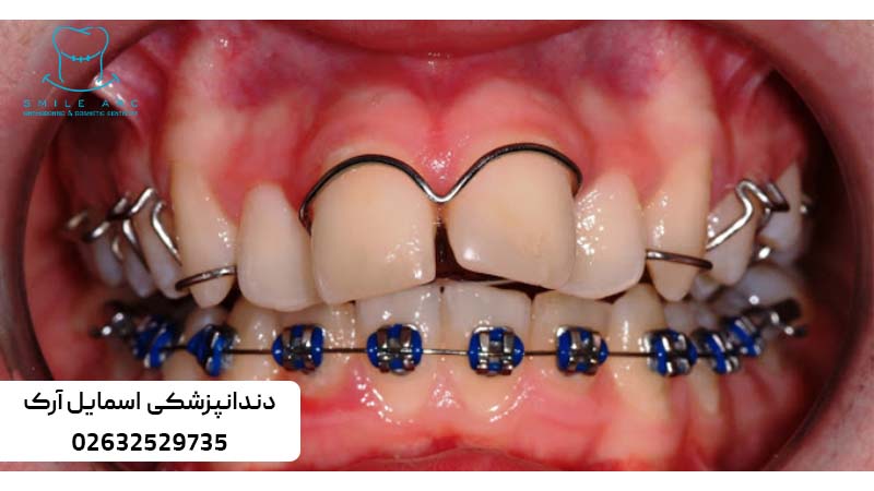 ارتودنسی کاموفلاژ