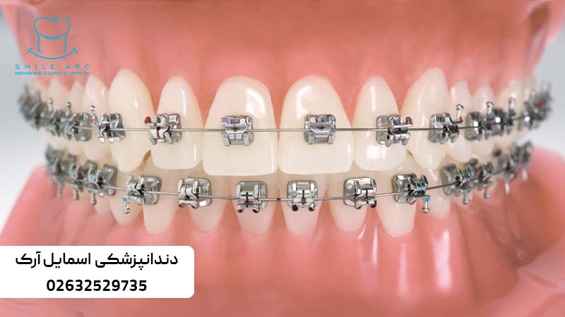 ارتودنسی کاموفلاژ